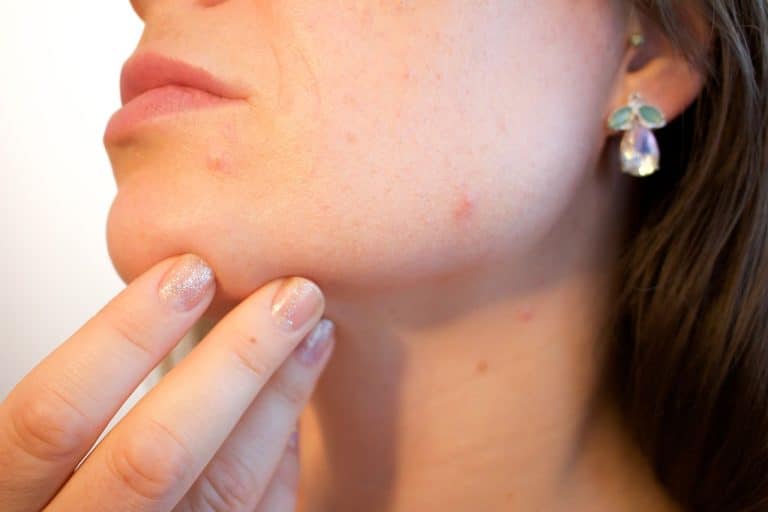 Les solutions naturelles pour se débarrasser rapidement des boutons
